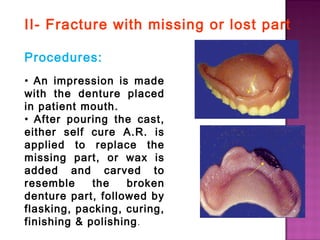 II- Fracture with missing or lost part
Procedures:
• An impression is made
with the denture placed
in patient mouth.
• After pouring the cast,
either self cure A.R. is
applied to replace the
missing part, or wax is
added and carved to
resemble
the
broken
denture part, followed by
flasking, packing, curing,
finishing & polishing .

 