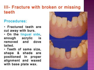 III- Fracture with broken or missing
teeth
Procedures:
• Fractured teeth are
cut away with burs.
• On the lingual side,
enough
acrylic
is
removed
and
dove
tailed.
• Teeth of same size,
shape & shade are
positioned in proper
alignment and waxed
with base plate wax.

 