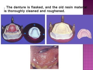 . The denture is flasked, and the old resin material
is thoroughly cleaned and roughened.

 