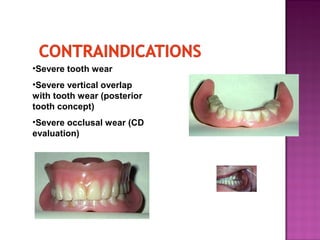 •Severe tooth wear
•Severe vertical overlap
with tooth wear (posterior
tooth concept)
•Severe occlusal wear (CD
evaluation)

 