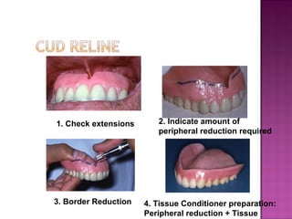 1. Check extensions

3. Border Reduction

2. Indicate amount of
peripheral reduction required

4. Tissue Conditioner preparation:
Peripheral reduction + Tissue

 