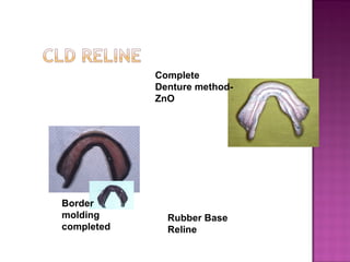 Complete
Denture methodZnO

Border
molding
completed

Rubber Base
Reline

 