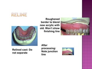 Roughened
border to blend
new acrylic with
old. Won’t show
finishing line

Relined cast: Do
not separate

After
processing:
Note junction
line

 