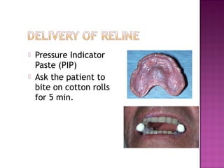 


Pressure Indicator
Paste (PIP)
Ask the patient to
bite on cotton rolls
for 5 min.

 