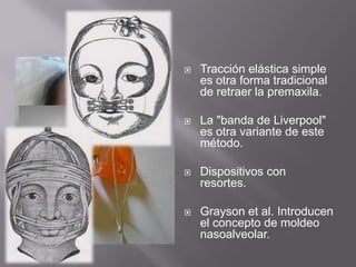 Tracción elástica simple es otra forma tradicional de retraer la premaxila.La "banda de Liverpool" es otra variante de este método.Dispositivos con resortes.Grayson et al. Introducen el concepto de moldeo nasoalveolar.