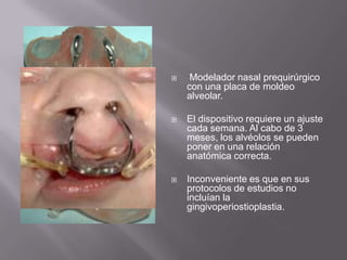  Modelador nasal prequirúrgico con una placa de moldeo alveolar.El dispositivo requiere un ajuste cada semana. Al cabo de 3 meses, los alvéolos se pueden poner en una relación anatómica correcta.Inconveniente es que en sus protocolos de estudios no incluían la gingivoperiostioplastia.