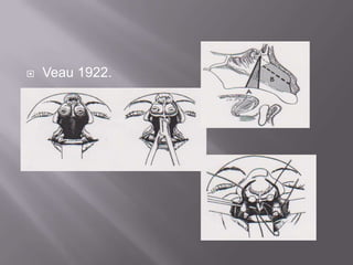 Veau 1922.
