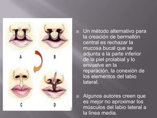 Un método alternativo para la creación de bermellón central es rechazar la mucosa bucal que se adjunta a la parte inferior de la piel prolabial y lo envuelve en la reparación, la conexión de los elementos del labio lateral.Algunos autores creen que es mejor no aproximar los músculos del labio lateral a la línea media.