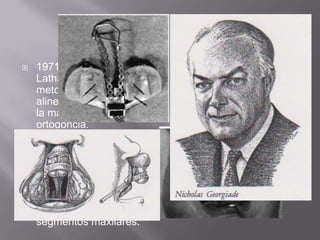 1971 Georgiadey Latham elaboraron un metodo para la alineacion correcta de la maxila con ortodoncia.1975 Lathamluego mejoró esta técnica de tracción, usando cadenas para retraer la premaxila junto con la aproximación de los segmentos maxilares.