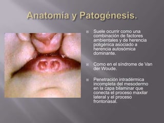 Anatomía y Patogénesis.Suele ocurrir como una combinación de factores ambientales y de herencia poligénica asociado a herencia autosómica dominante.Como en el síndrome de Van der Woude.Penetración intradérmica incompleta del mesodermo en la capa bilaminar que conecta el proceso maxilar lateral y el proceso frontonasal.