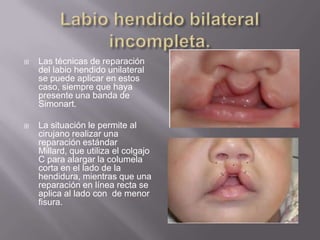 Labio hendido bilateral incompleta.Las técnicas de reparación del labio hendido unilateral se puede aplicar en estos caso, siempre que haya presente una banda de Simonart.La situación le permite al cirujano realizar una reparación estándar Millard, que utiliza el colgajo C para alargar la columela corta en el lado de la hendidura, mientras que una reparación en línea recta se aplica al lado con  de menor fisura. 