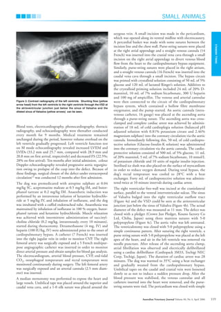 Blood tests, electrocardiography, phonocardiography, thoracic
radiography, and echocardiography were thereafter conducted
every month for 9 months. Medical treatment remained
unchanged during the period, however volume overload on the
left ventricle gradually progressed. Left ventricle function test
on M mode echocardiography revealed increased LVIDd and
LVIDs (33.2 mm and 25.7 mm, compared with 28.9 mm and
20.8 mm on first arrival, respectively) and decreased FS (22.5%;
28% on first arrival). Ten months after initial admission, colour
Doppler echocardiography revealed progressive aortic regurgita-
tion owing to prolapse of the cusp into the defect. Because of
these findings, surgical closure of the defect under extracorporal
circulation12
was conducted 12 months after first admission.
The dog was premedicated with atropine sulphate at 0.04
mg/kg SC, acepromazine maleate at 0.5 mg/kg IM, and butor-
phanol tartrate at 0.2 mg/kg IM. Anaesthetic induction was
performed by an intravenous infusion of ketamine hydrochlo-
ride at 5 mg/kg IV, and inhalation of isoflurane, and the dog
was intubated with a cuffed endotracheal tube. Anaesthesia was
maintained by inhalation of isoflurane in 100 % oxygen, butor-
phanol tartrate and ketamine hydrochloride. Muscle relaxation
was achieved with intermittent administration of succinyl-
choline chloride (0.2 mg/kg, intravenously, every 10 minutes),
started during thoracotomy. Dexamethasone (4 mg, IV) and
heparin (100 IU/kg, IV) were administered prior to the onset of
cardiopulmonary bypass. A catheter (7 French) was inserted
into the right jugular vein in order to monitor CVP. The right
femoral artery was surgically exposed and a 5 French multipur-
pose angiographic catheter was inserted in order to monitor
direct arterial pressure and obtain samples for blood gas analysis.
The electrocardiogram, arterial blood pressure, CVP, end-tidal
CO2, oesophageal temperature and rectal temperature were
monitored continuously during surgery. The left femoral artery
was surgically exposed and an arterial cannula (2.5 mm diam-
eter) was inserted.
A median sternotomy was performed to expose the heart and
large vessels. Umbilical tape was placed around the superior and
caudal vena cava, and a 1-0 silk suture was placed around the
azygous vein. A small incision was made in the pericardium,
which was opened along its ventral midline with electrocautery.
A percardial basket was made with some sutures between the
incision line and the chest wall. Purse-string sutures were placed
at the right atrial appendage and a straight venous cannula (14
French) was inserted into the cranial vena cava through a small
incision on the right atrial appendage to divert venous blood
flow from the heart to the cardiopulmonary bypass equipment.
Similarly, purse-string sutures were placed in the right atrium,
and a straight venous cannula (16 French) was inserted into the
caudal vena cava through a small incision. The bypass circuit
was primed with crystalloid solution consisting of 50 mL of 5%
glucose and 120 mL of lactated Ringer’s solution. Additives to
the crystalloid priming solution included 24 mL of 20% D-
mannitol, 10 mL of 7% sodium bicarbonate, 300 U heparin
and 100 mg of ampicillin. The venous and arterial cannulae
were then connected to the circuit of the cardiopulmonary
bypass system, which contained a hollow fibre membrane
oxygenator, and the pump started. An aortic cannula (intra-
venous catheter, 16 gauge) was placed at the ascending aorta
through a purse-string suture. The ascending aorta was cross-
clamped and complete cardiac arrest was achieved by adminis-
tration of 18 mL of cold cardioplegia solution (balanced pH
adjusted solution with 0.81% potassium citrate and 2.46%
magnesium sulphate) into the coronary circulation via the aortic
cannula. Immediately following this, 50 mL of cold cardiopro-
tective solution (Glucose-Insulin-K solution) was administered
into the coronary circulation via the aortic cannula. The cardio-
protective solution consisted of 500 mL of 5% glucose, 11 mL
of 20% mannitol, 5 mL of 7% sodium bicarbonate, 10 mmol/L
of potassium chloride and 10 units of regular insulin injection.
Sterilised ice slush was also placed on the surface of myocardium
in order to reduce oxygen demand. During total bypass, the
dog’s rectal temprature was cooled to 28°C with a heat
exchanger. Forty mL of cardioprotective solution was adminis-
tered twice at 10 minute intervals during cardiac arrest.
The right ventricular free-wall was incised at the craniolateral
surface, parallel to the ventral interventricular sulcus. The sinus
of Valsalva bulged into the right ventricular outflow tract
(Figure 4a) and the VSD could be seen at the atrioventricular
junction just below the sinus of Valsalva (Figure 4b). The actual
diameter of the defect was measured as 11 mm. The defect was
closed with a pledget (Crown Jun Pledget, Kouno factory Co
Ltd, Chiba, Japan) using three mattress sutures with 5-0
polypropylene (Figure 4c). The aortic valve was left untreated.
The ventriculotomy was closed with 5-0 polypropylene using a
simple continuous pattern. After suturing the right ventricle, a
purse string suture with 5-0 polypropylene was placed at the left
apex of the heart, and air in the left ventricle was removed via
needle puncture. After release of the ascending aorta clamp,
atrial fibrillation was observed and electrically defibrillated
using a cardiac defibrillator (Cardiopack 3M33, Tochigi NEC
Corp, Tochigi, Japan). The duration of cardiac arrest was 28
minutes. The dog was warmed to 35°C using a heat exchanger
and gradually weaned from the cardiopulmonary bypass.
Umbilical tapes on the caudal and cranial vein were loosened
slowly so as not to induce a sudden pressure drop. After the
blood pressure was stabilised, the venous cannulae and all
catheters inserted into the heart were removed, and the purse-
string sutures were tied. The pericardium was closed with simple
SMALL ANIMALS
SMALL
ANIMALS
119
Australian Veterinary Journal Volume 84, No 4, April 2006
Figure 3. Contrast radiography of the left ventricle. Shunting flow (yellow
arrow head) from the left ventricle to the right ventricle through the VSD at
the atrioventricular junction just below the sinus of Valsalva and the
dilated sinus of Valsalva (yellow arrows) can be seen.
AVJApril06N.qxd 24/03/2006 10:27 AM Page 119
 