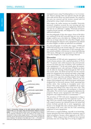 interrupted sutures using 5-0 polypropylene at 1 to 2 cm inter-
vals. Thoracic drainage tubes were placed in the left and right
chest walls and the thorax was closed routinely. The cannula in
the aorta was removed and the incision sutured with 6-0
polypropylene using a simple continuous pattern.
After surgery, the cardiac murmur was inaudible. Ventricular
premature complexes occurred the next morning and were
corrected with lignocaine injection (2 mg/kg bolus, followed 30
min later by an additional 1 mg/kg). Ventricular premature
complexes became sporadic, and disappeared in 2 days without
additional medication.
On echocardiography 16 days after surgery, closure of the defect
was confirmed on the left ventricular long axis view and the
pledget could be seen at the defect site. Prolapse of the aortic
valve was no longer observed. On colour-flow Doppler, shunt
flow had disappeared. Because aortic regurgitation was relieved
on colour Doppler, no follow up medication was scheduled.
On echocardiography 14 months after surgery, LVIDd and
LVIDs had returned to the normal range (22.7 mm and 15.1
mm, respectively). This improvement in left ventricular func-
tion seemed ascribable to the decrease in volume load following
VSD closure. Although aortic regurgitation was still evident on
colour-flow Doppler, the cough was no longer observed.
Discussion
The association of VSD and aortic regurgitation is well recog-
nised in human patients, with a reported prevalence of 3% to
8%.13
In patients with a defect located at the atrioventricular
junction just below the sinus of Valsalva, VSD contributes to
aortic regurgitation.4,14
In the early systolic phase, the anatomi-
cally unsupported aortic valve and sinus of Valsalva are drawn
into the defect by shunting of blood through the VSD. In the
mid systolic phase, the blood ejected from the left ventricle
pushes the unsupported sinus outward and makes a large bulge
in the sinus of Valsalva. In the diastolic phase, the free margins
of the three aortic cusps close, providing complete closure of the
valve as a result of intra-aortic pressure. However, the free
margin of the prolapsed cusp is then forced down and becomes
elongated due to intra-aortic pressure, finally separating from
another valves, thus resulting in incomplete aortic valve
closure.4
Once aortic regurgitation is established, the jet causes
thickening and rolling of the cusps of the aortic valve. This
aggravates aortic regurgitation and predisposes to bacterial
endocarditis. The severity of aortic regurgitation determines the
prognosis. Because aortic regurgitation with VSD is usually
progressive, early surgical treatment is recommended.15,16
The prevalence of VSD with aortic regurgitation in dogs is
unknown, and the prognosis has been reported as poor.13
In
dogs VSD is not routinely closed surgically. In the present case,
early surgical treatment was indicated because the animal had
volume overload, partially due to aortic regurgitation, and
because it was thought that early occlusion of the VSD could
stop prolapse of the aortic valve into the VSD, minimising
progression of aortic regurgitation.
VSD closure is a surgical challenge, especially in toy breed dogs.
Various operations have been conducted as treatments, some of
which are palliative, because a direct approach to the VSD is
difficult.17
While surgical closure of VSD has been reported
previously, most were in large dogs (15 to 25 kg in weight),18,19
SMALL ANIMALS
120
SMALL
ANIMALS
Figure 4. Intracardiac findings on the right ventricle outflow incision
(cranial side is on the upper side) and hand-drawn diagram of suture
pattern a. On the right ventricle outflow incision, the bulging sinus of Valsalva
can be observed. Sterilised ice slush was placed on the surface of the
myocardium in order to reduce oxygen demand. b. The sinus of Valsalva was
retracted, and the VSD was found at the atrioventricular junction just below the
sinus of Valsalva. The diameter of the defect was 11 mm. c. The defect was
closed with a pledget using three mattress sutures with 5-0 polypropylene.
a
b
c
pledget
aorta
pulmonary artery
ventricular septal defect
5-0 polypropylene
suture
AVJApril06N.qxd 24/03/2006 10:27 AM Page 120
 