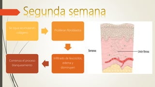 Se sigue acumulando
colágeno
Proliferan fibroblastos
Infiltrado de leucocitos,
edema y
disminuyen
Comienza el proceso
blanqueamiento
 