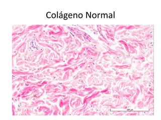 Colágeno Normal
 