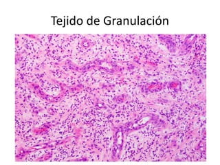 Tejido de Granulación
 