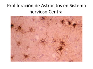 Proliferación de Astrocitos en Sistema
nervioso Central
 