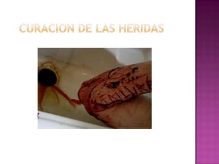         Fases de las heridas
