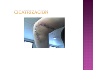 Degradación de colágenometaloproteinasasElastasa de los neutrofilos 