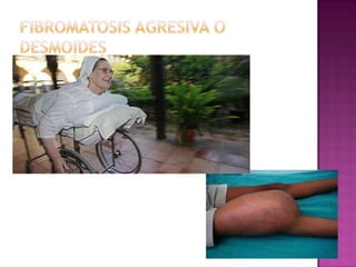 Formación de cantidades excesiva de tejido de granulación