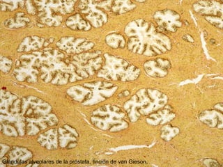 Glándulas alveolares de la próstata, tinción de van Gieson.
 
