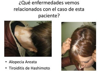 ¿Qué enfermedades vemos
relacionados con el caso de esta
paciente?
• Alopecia Areata
• Tiroiditis de Hashimoto
 