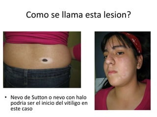 Como se llama esta lesion?
• Nevo de Sutton o nevo con halo
podria ser el inicio del vitiligo en
este caso
 
