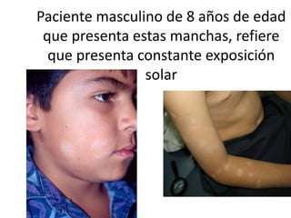 Paciente masculino de 8 años de edad
que presenta estas manchas, refiere
que presenta constante exposición
solar
 