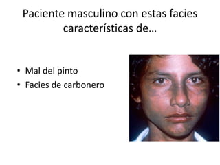 Paciente masculino con estas facies
características de…
• Mal del pinto
• Facies de carbonero
 