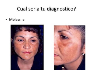 Cual seria tu diagnostico?
• Melasma
 