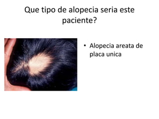 Que tipo de alopecia seria este
paciente?
• Alopecia areata de
placa unica
 