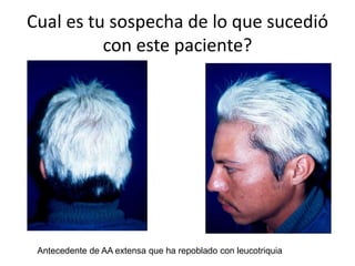 Antecedente de AA extensa que ha repoblado con leucotriquia
Cual es tu sospecha de lo que sucedió
con este paciente?
 