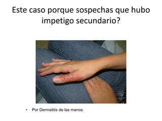 Este caso porque sospechas que hubo
impetigo secundario?
• Por Dermatitis de las manos
 