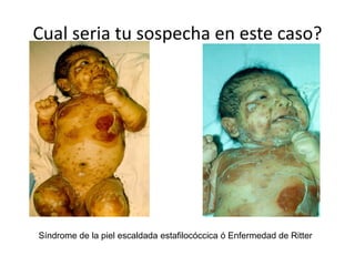 Síndrome de la piel escaldada estafilocóccica ó Enfermedad de Ritter
Cual seria tu sospecha en este caso?
 