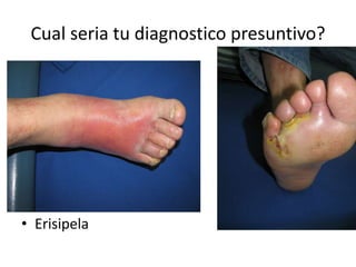 Cual seria tu diagnostico presuntivo?
• Erisipela
 