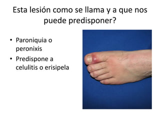 Esta lesión como se llama y a que nos
puede predisponer?
• Paroniquia o
peronixis
• Predispone a
celulitis o erisipela
 