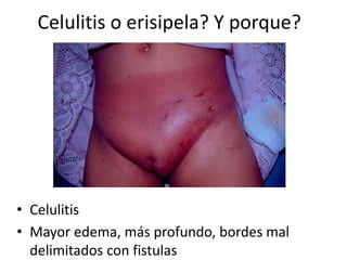 Celulitis o erisipela? Y porque?
• Celulitis
• Mayor edema, más profundo, bordes mal
delimitados con fistulas
 