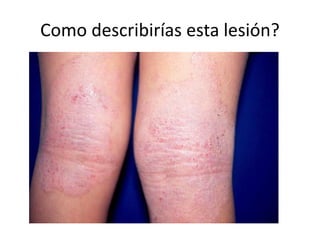 Como describirías esta lesión?
 