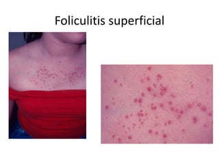 Foliculitis superficial
 