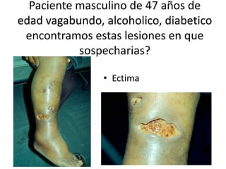 Paciente masculino de 47 años de
edad vagabundo, alcoholico, diabetico
encontramos estas lesiones en que
sospecharias?
• Ectima
 
