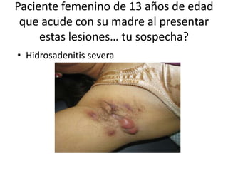 Paciente femenino de 13 años de edad
que acude con su madre al presentar
estas lesiones… tu sospecha?
• Hidrosadenitis severa
 