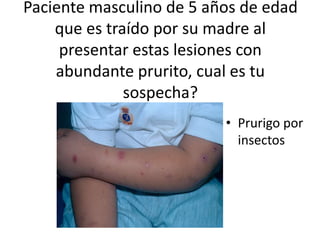 Paciente masculino de 5 años de edad
que es traído por su madre al
presentar estas lesiones con
abundante prurito, cual es tu
sospecha?
• Prurigo por
insectos
 