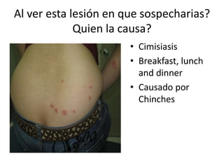 Al ver esta lesión en que sospecharias?
Quien la causa?
• Cimisiasis
• Breakfast, lunch
and dinner
• Causado por
Chinches
 