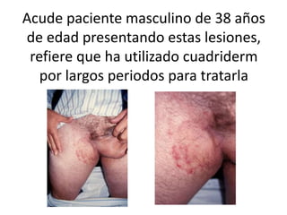 Acude paciente masculino de 38 años
de edad presentando estas lesiones,
refiere que ha utilizado cuadriderm
por largos periodos para tratarla
 