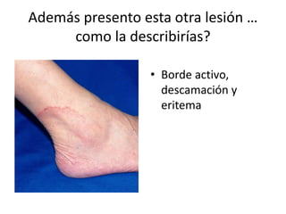 Además presento esta otra lesión …
como la describirías?
• Borde activo,
descamación y
eritema
 