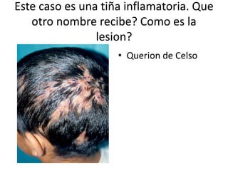 Este caso es una tiña inflamatoria. Que
otro nombre recibe? Como es la
lesion?
• Querion de Celso
 