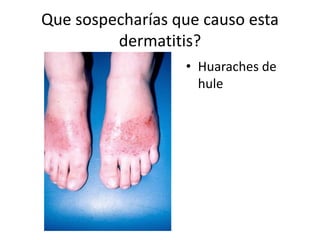 Que sospecharías que causo esta
dermatitis?
• Huaraches de
hule
 