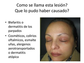 Como se llama esta lesión?
Que lo pudo haber causado?
• Blefaritis o
dermatitis de los
parpados
• Cosméticos, colirios
oftalmicos, esmalte
uñas, alergenos
aerotransportados
o dermatitis
atópica
 