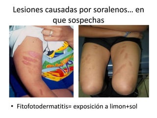 Lesiones causadas por soralenos… en
que sospechas
• Fitofotodermatitis= exposición a limon+sol
 