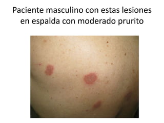 Paciente masculino con estas lesiones
en espalda con moderado prurito
 